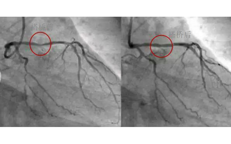 深圳市模具廠對(duì)心臟支架的關(guān)注，國(guó)產(chǎn)化的道路有多長(zhǎng)？
